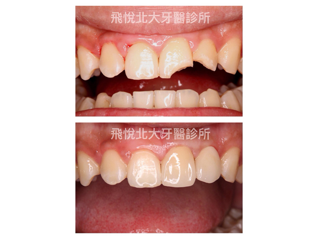 全瓷牙冠案例分享