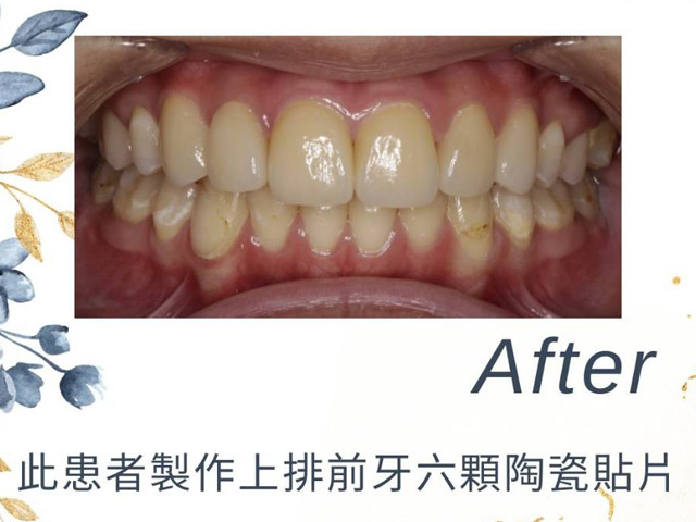 美學貼片案例分享